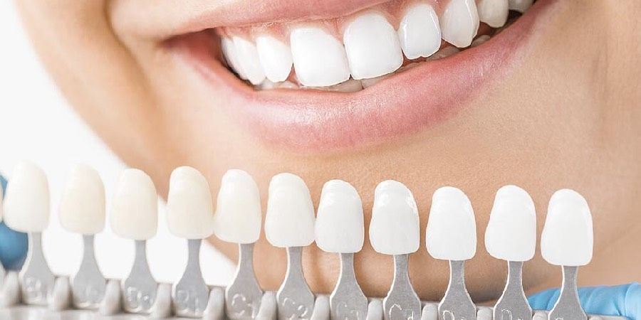 ابتسامة هوليوود