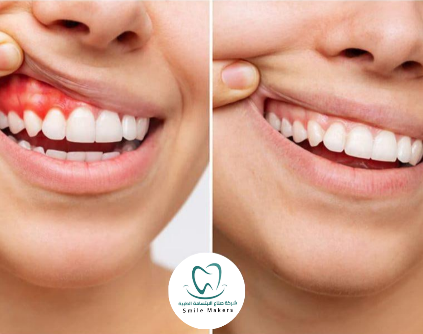 معالجات لثة